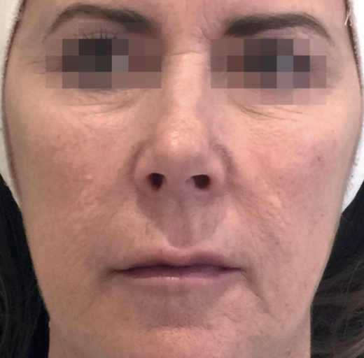 Before/After Image